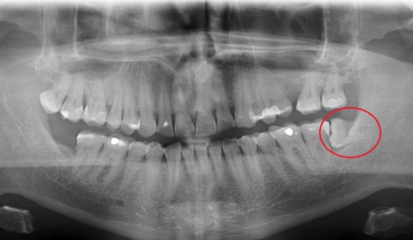 Zatrzymany częściowo ząb mądrości w położeniu poziomym