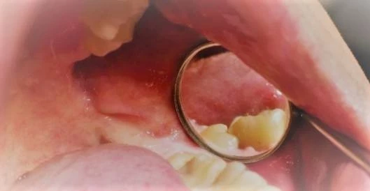 Ząb mądrości w jamie ustnej przed zabiegiem