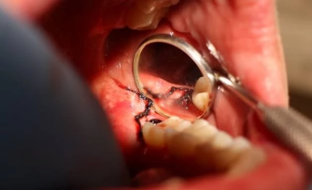 Stan po zabiegu i zaopatrzeniu rany szwami