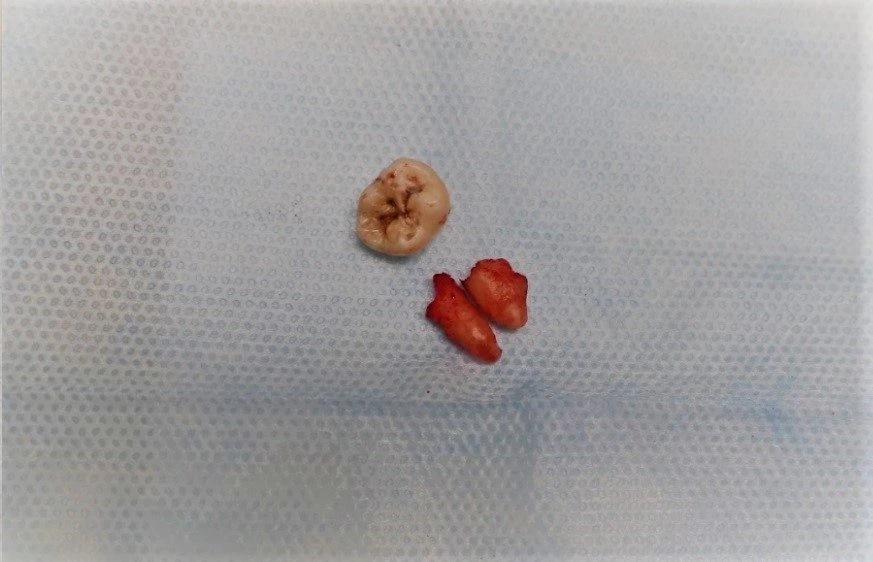 Zniszczona próchnicowo korona i korzenie "ósemki" po zabiegu